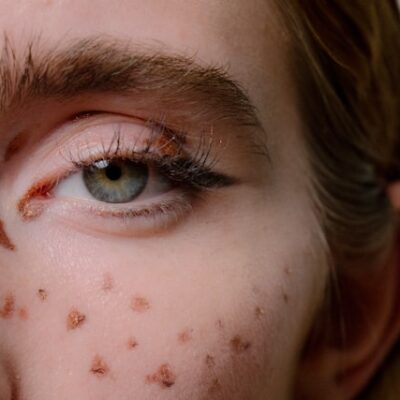 What You Should Know About Eye Herpes